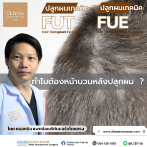 ทำไมต้องหน้าบวมหลังปลูกผม 