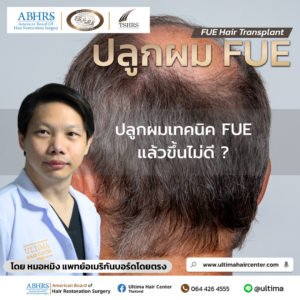 ปลูกผม FUE แล้วขึ้นไม่ดี