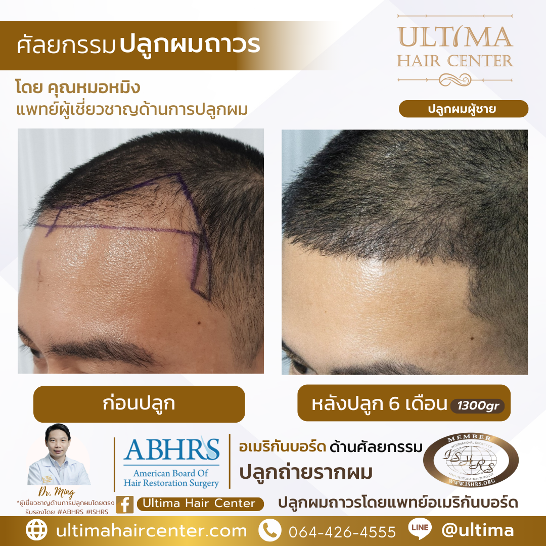 หัวล้านตัว m ทรงผม