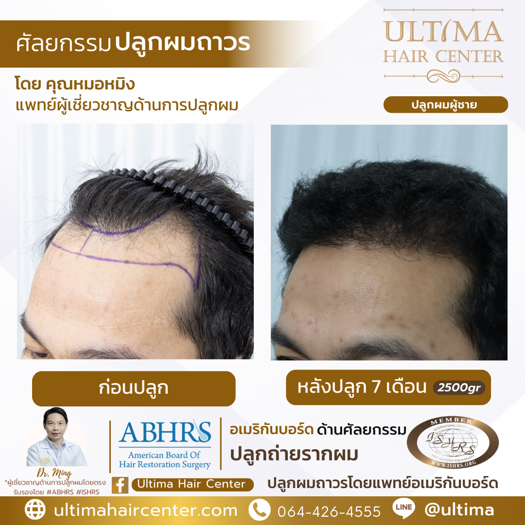 หัวล้านตัว m ทรงผม