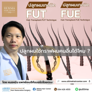 ปลูกผมใช้กราฟผมคนอื่นได้ไหม