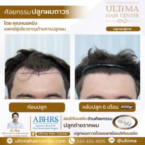 หัวล้านตัว m ทรงผม