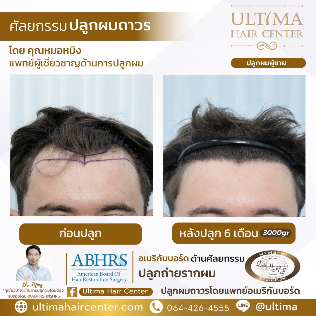 หัวล้านตัว m ทรงผม