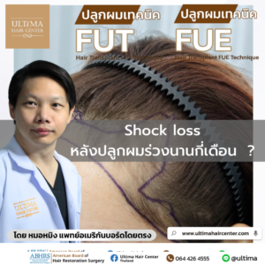 shock loss หลังปลูกผมร่วงนานกี่เดือน