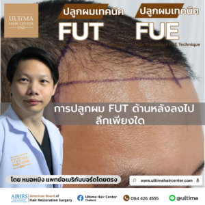 การปลูกผม FUT ด้านหลังลงไปลึกเพียงใด