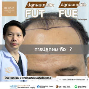 การปลูกผม คือ