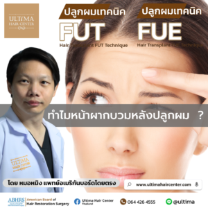 ทำไมหน้าผากบวมหลังปลูกผม