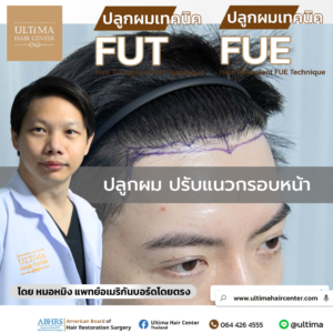 ปลูกผม ปรับแนวกรอบหน้า