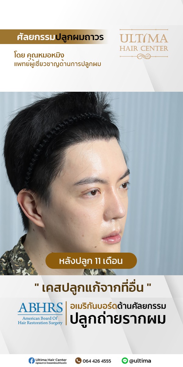 ปลูกผม ปรับแนวกรอบหน้า