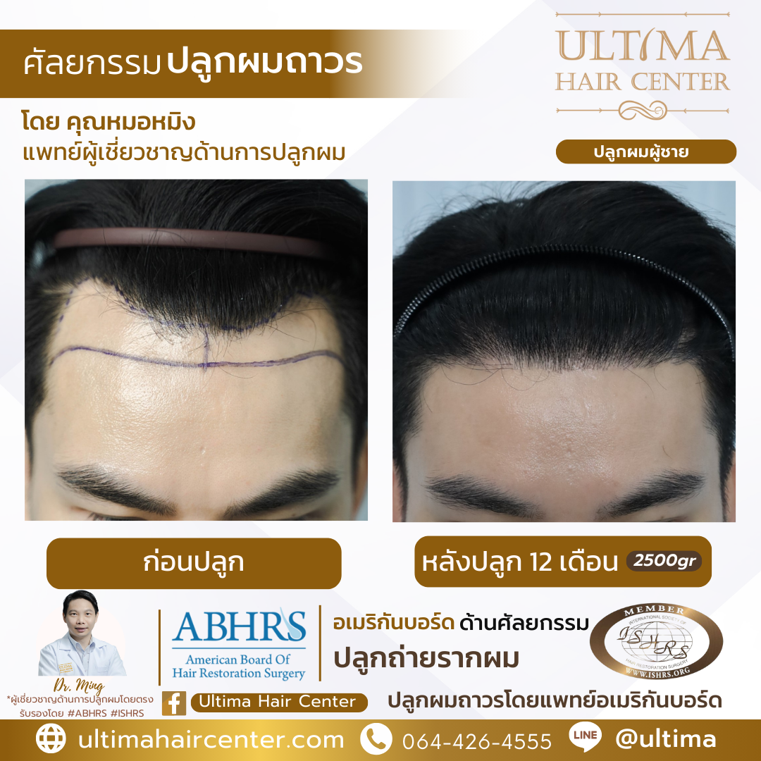 ผม เว้า M