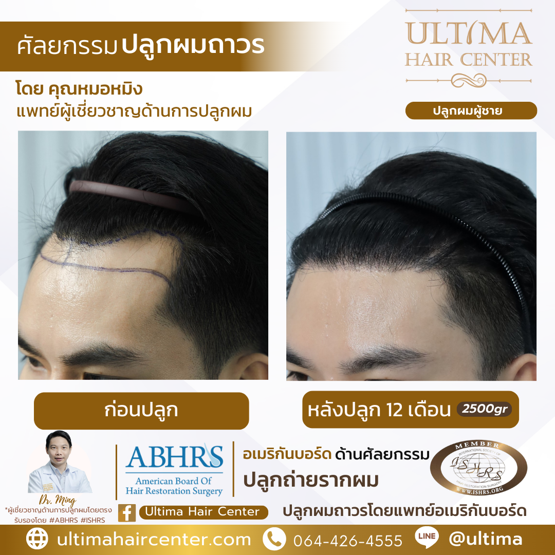 ผม เว้า M