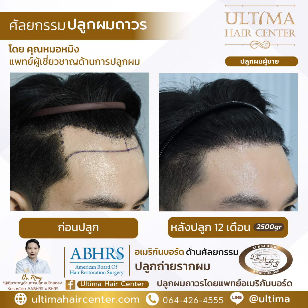 ผม เว้า M