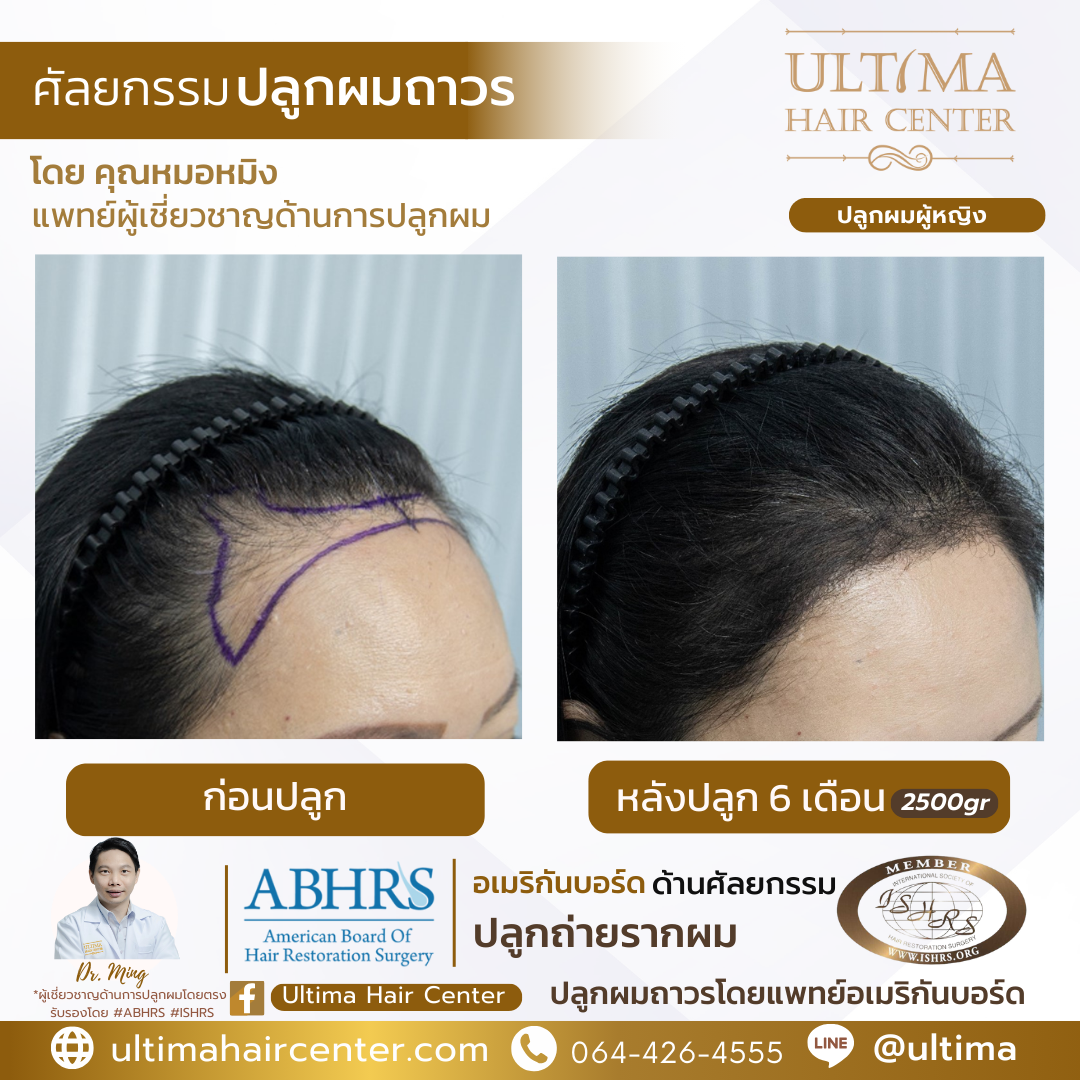 ผมบาง หน้าผากกว้าง เกิดจากอะไร