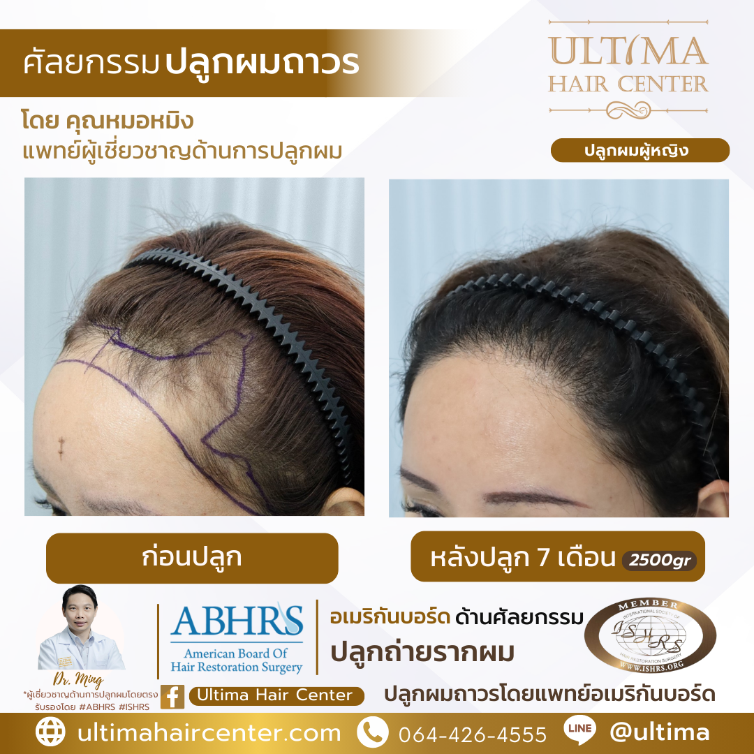 ผมบาง หน้าผากกว้าง เกิดจากอะไร