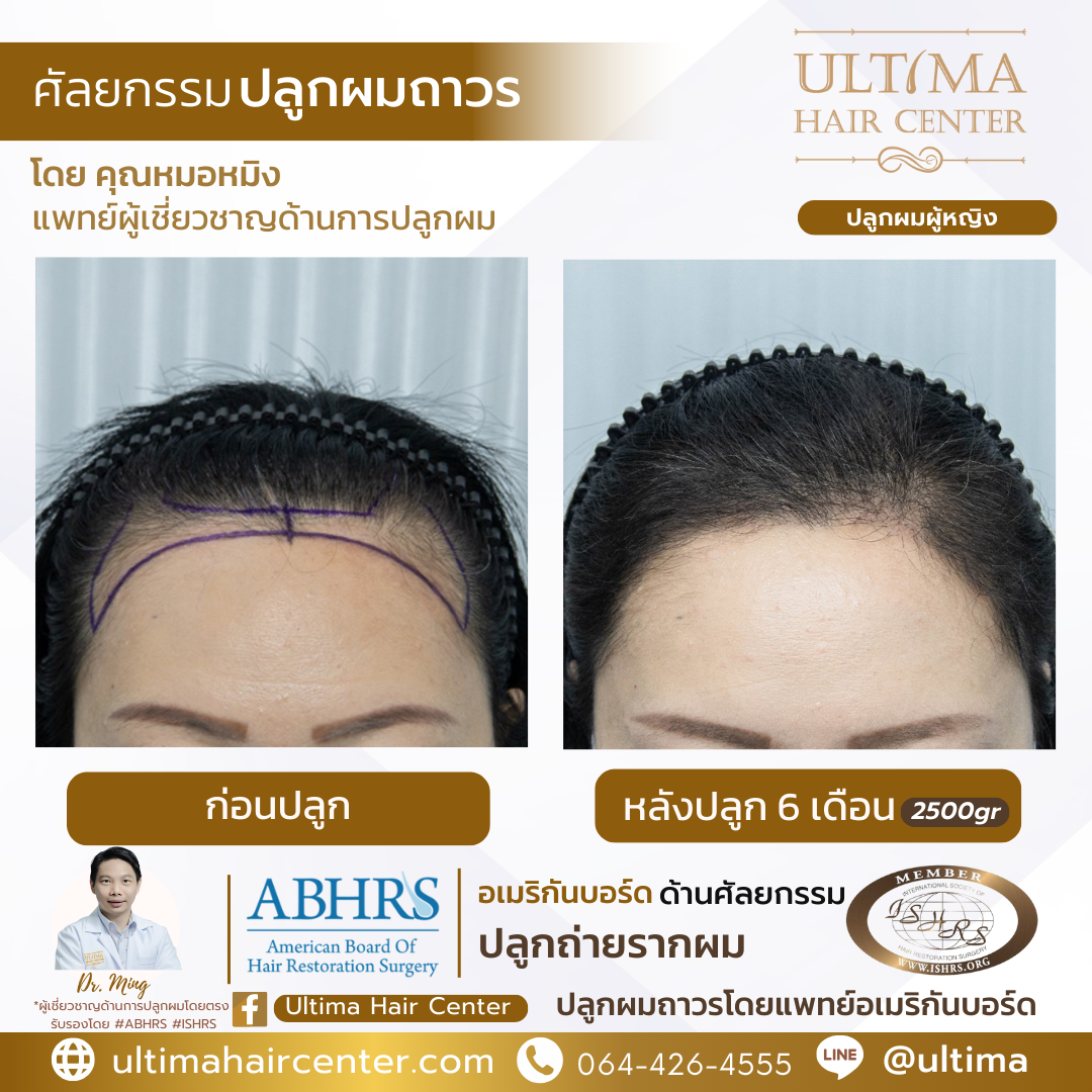 ผมบาง หน้าผากกว้าง เกิดจากอะไร