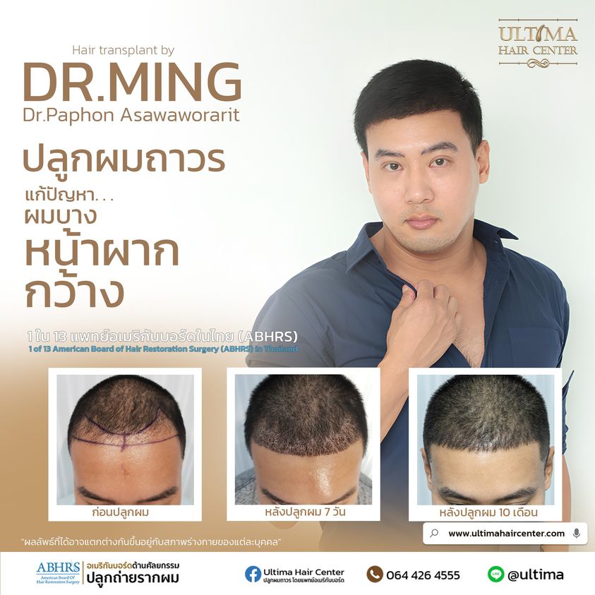 ปลูกผมแก้ไข ปลูกผมรอบสอง