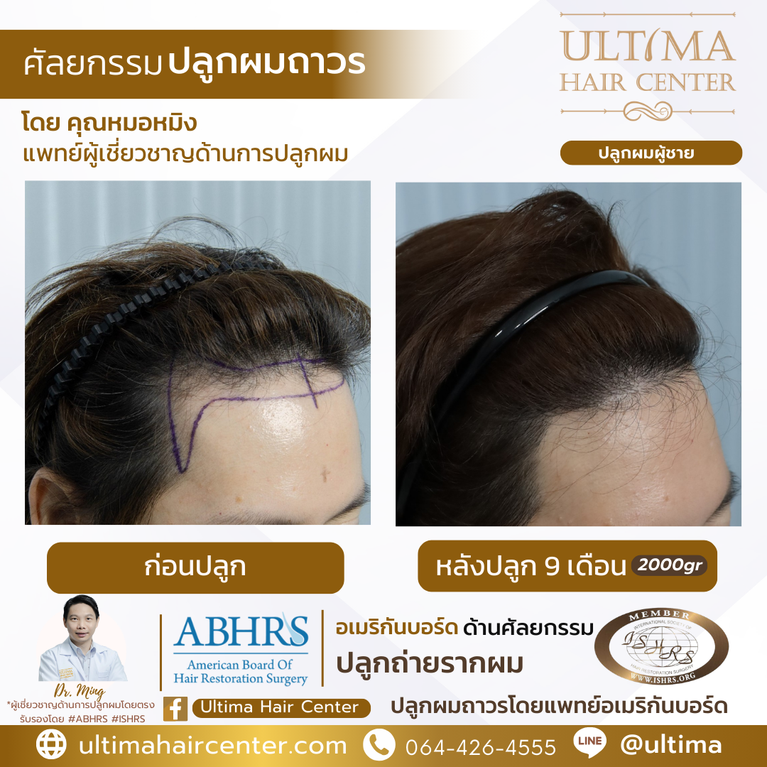 ปลูกผมเจ็บไหม