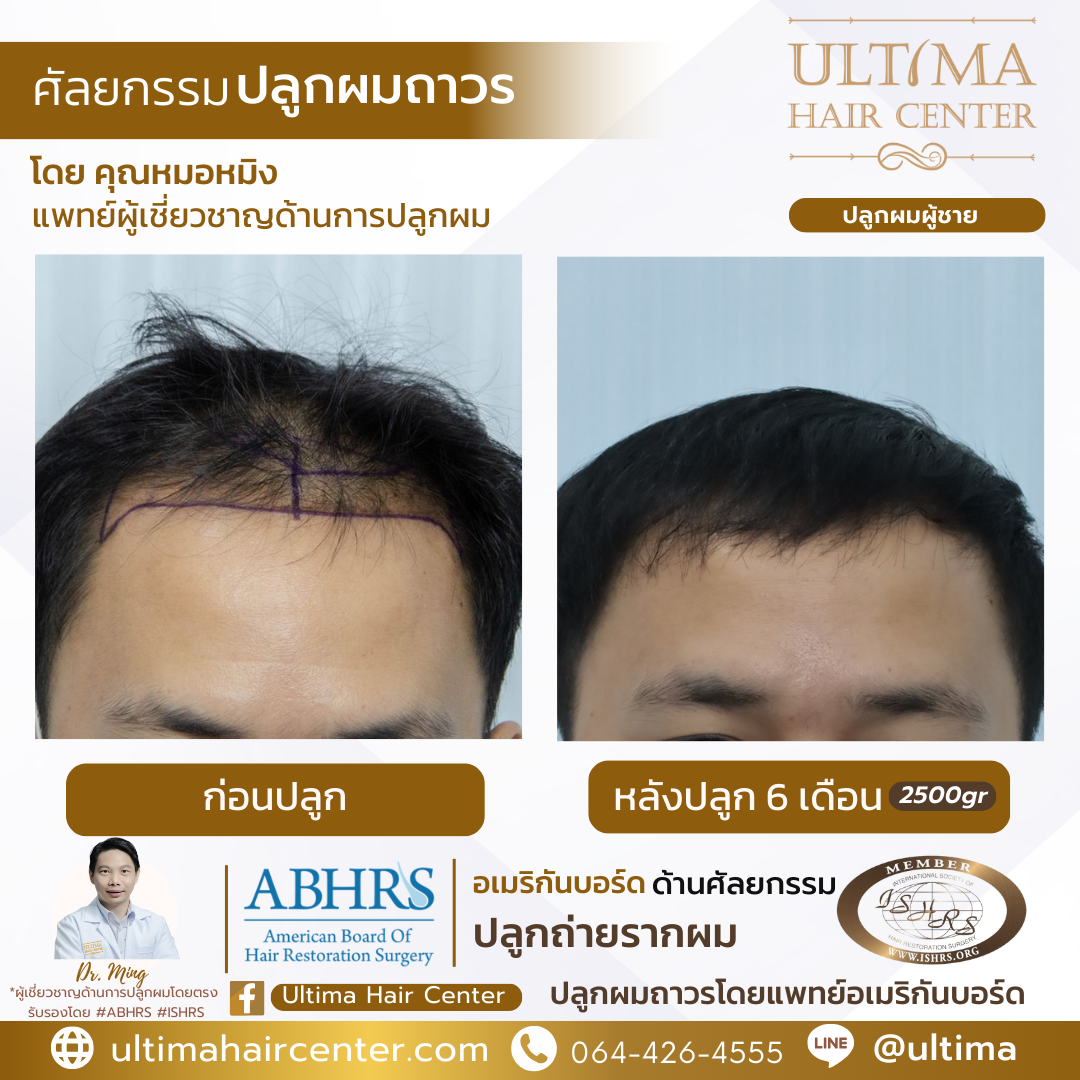 ปลูกผมเจ็บไหม