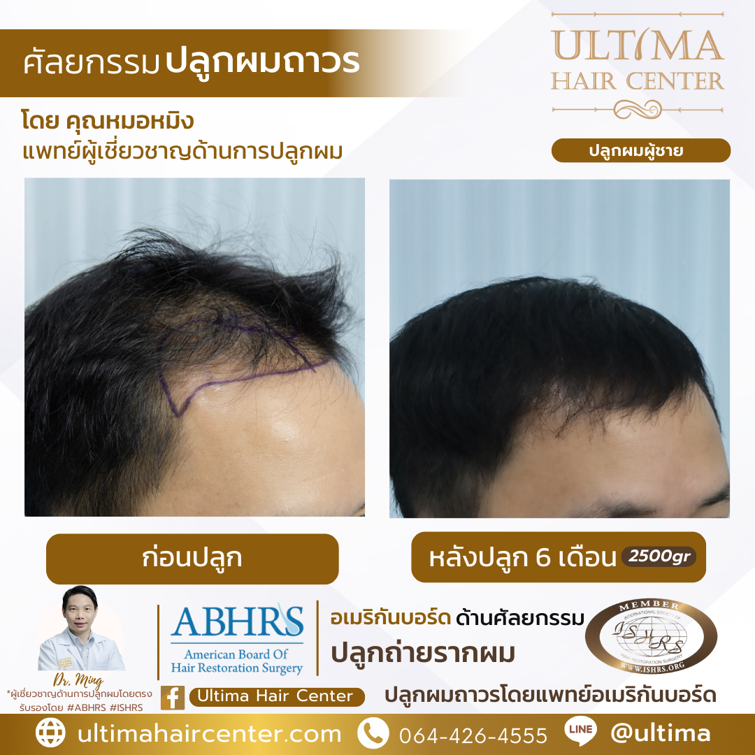 ทำไมปลูกผมห้ามโดนแดด