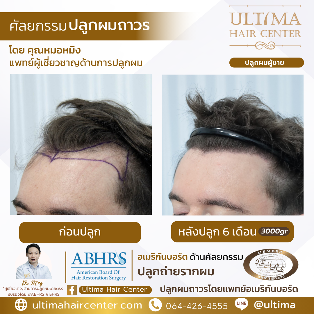 ทำไมปลูกผมห้ามโดนแดด
