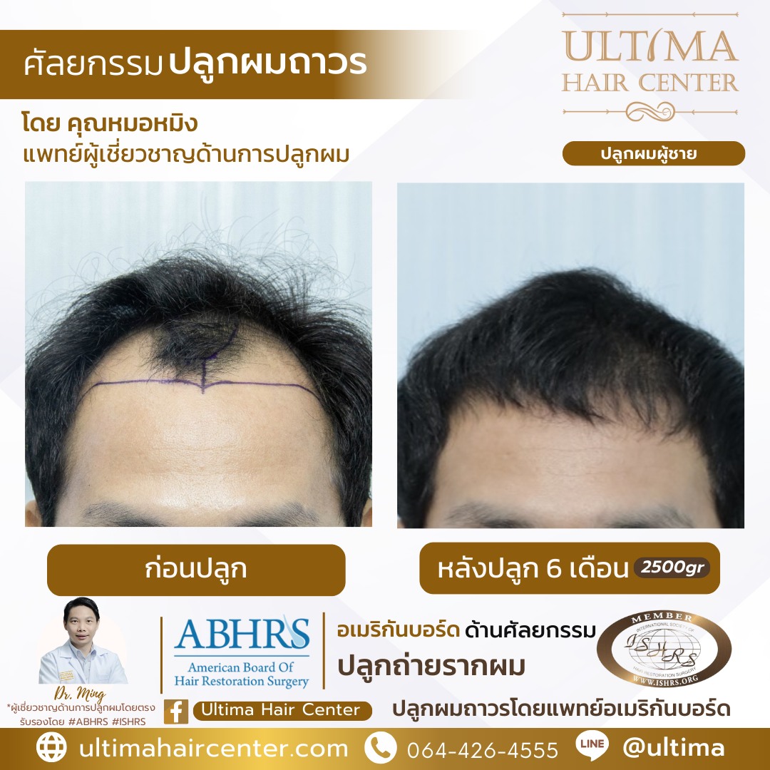 ผมบางกลางหัว ผู้ชาย