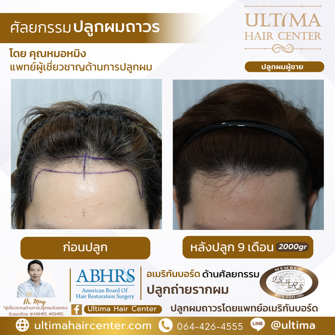 ผมบางกลางหัว ผู้ชาย