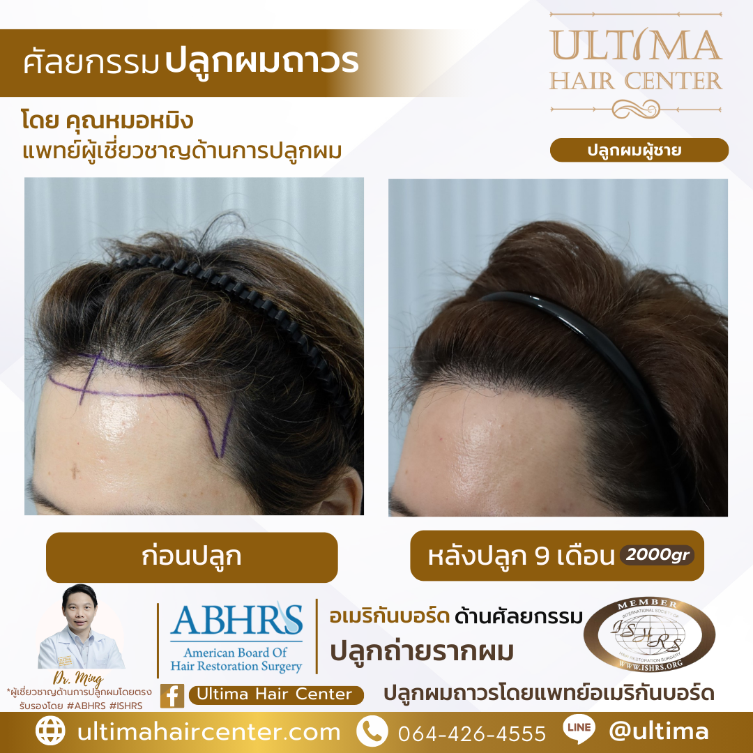 ผมบางกลางหัว ผู้ชาย