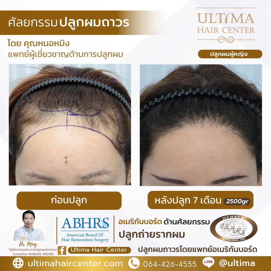 ผมบางกลางศีรษะ ผู้หญิง 