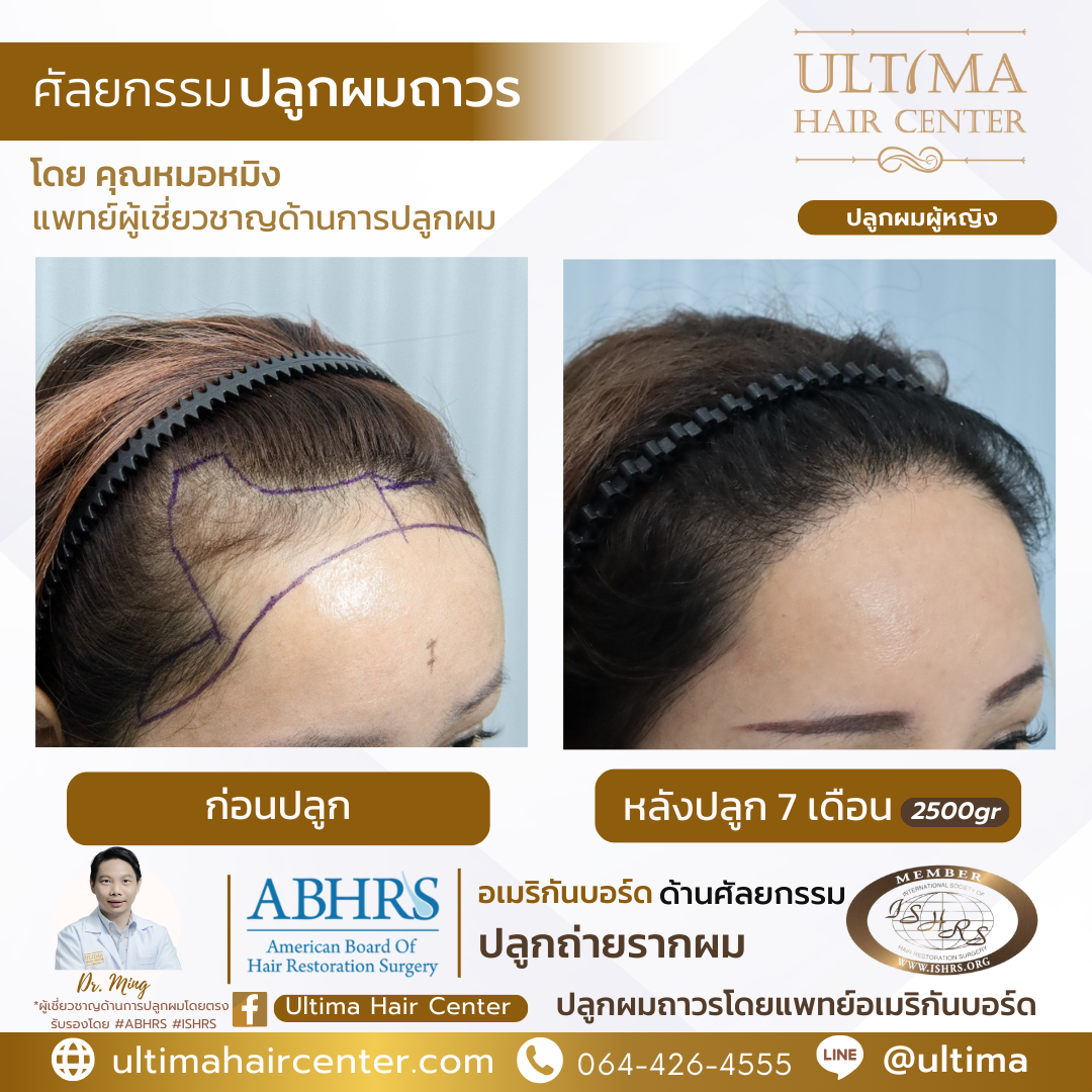 ผมบางกลางศีรษะ ผู้หญิง 