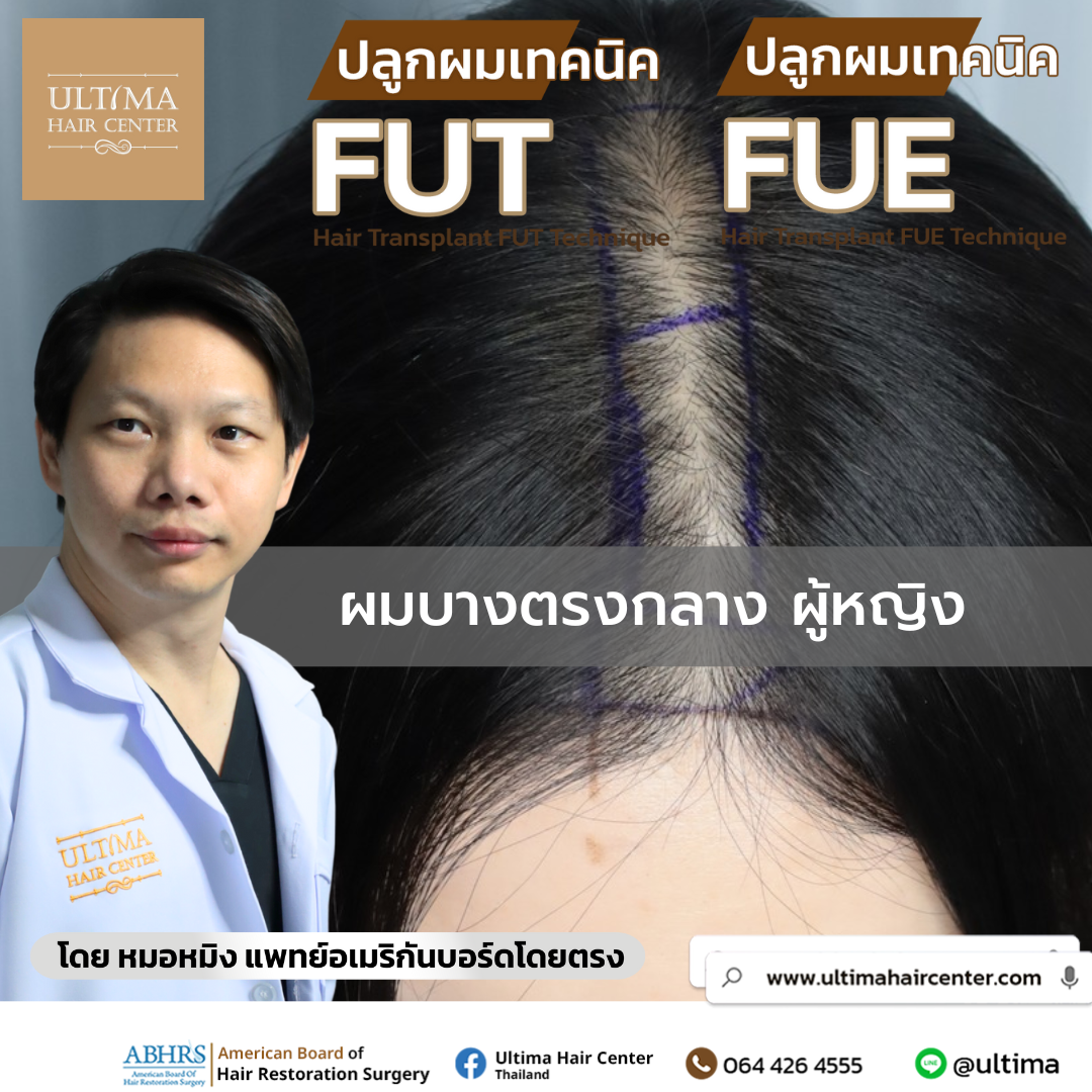 ผมบางกลางศีรษะ ผู้หญิง 