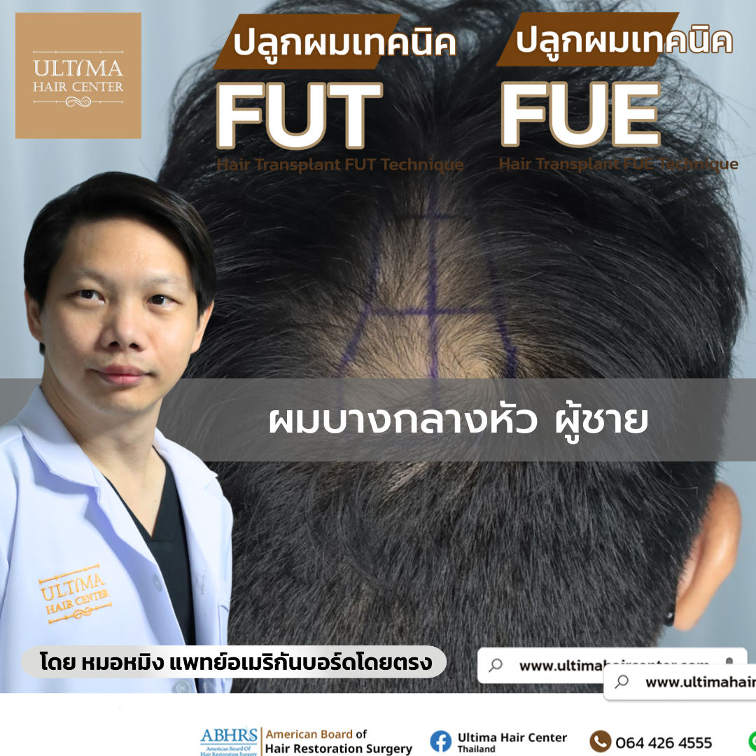 ผมบางกลางหัว ผู้ชาย