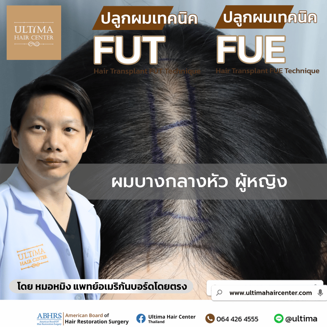 ผมบางกลางหัว ผู้หญิง