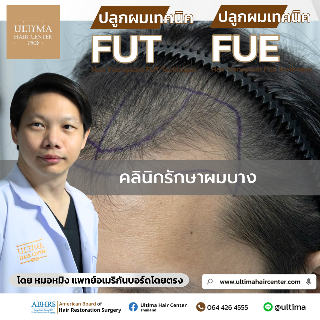 คลินิกรักษาผมบาง