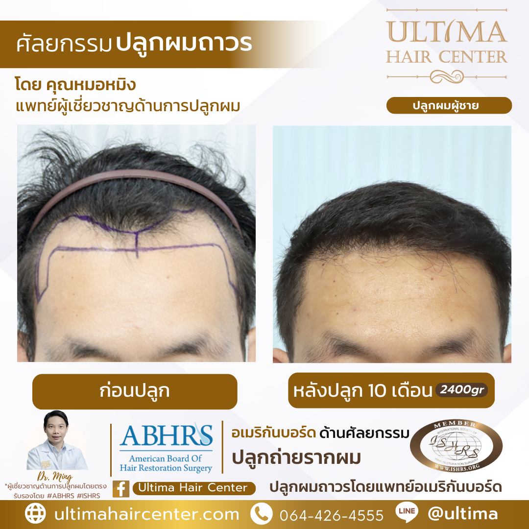 ปลูกผมแล้วจะร่วงอีกไหม