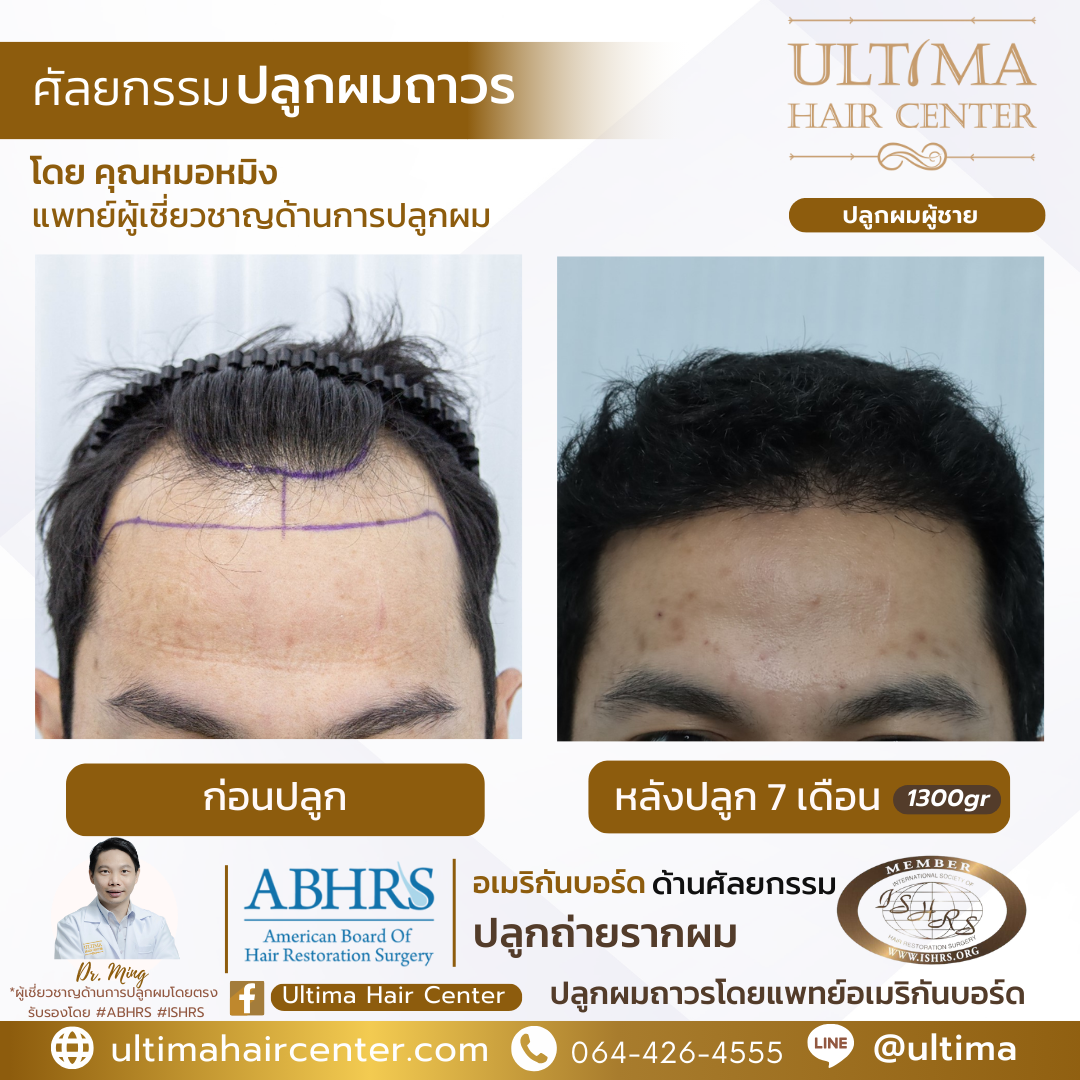 แก้ คิ้วบาง ผู้ชาย ด้วยการปลูกคิ้วได้ไหม 