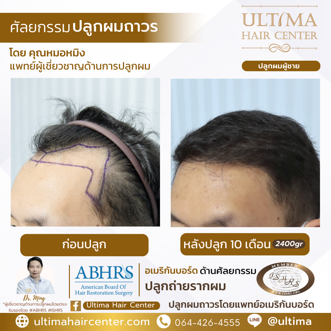 ปลูกผมแล้วจะร่วงอีกไหม