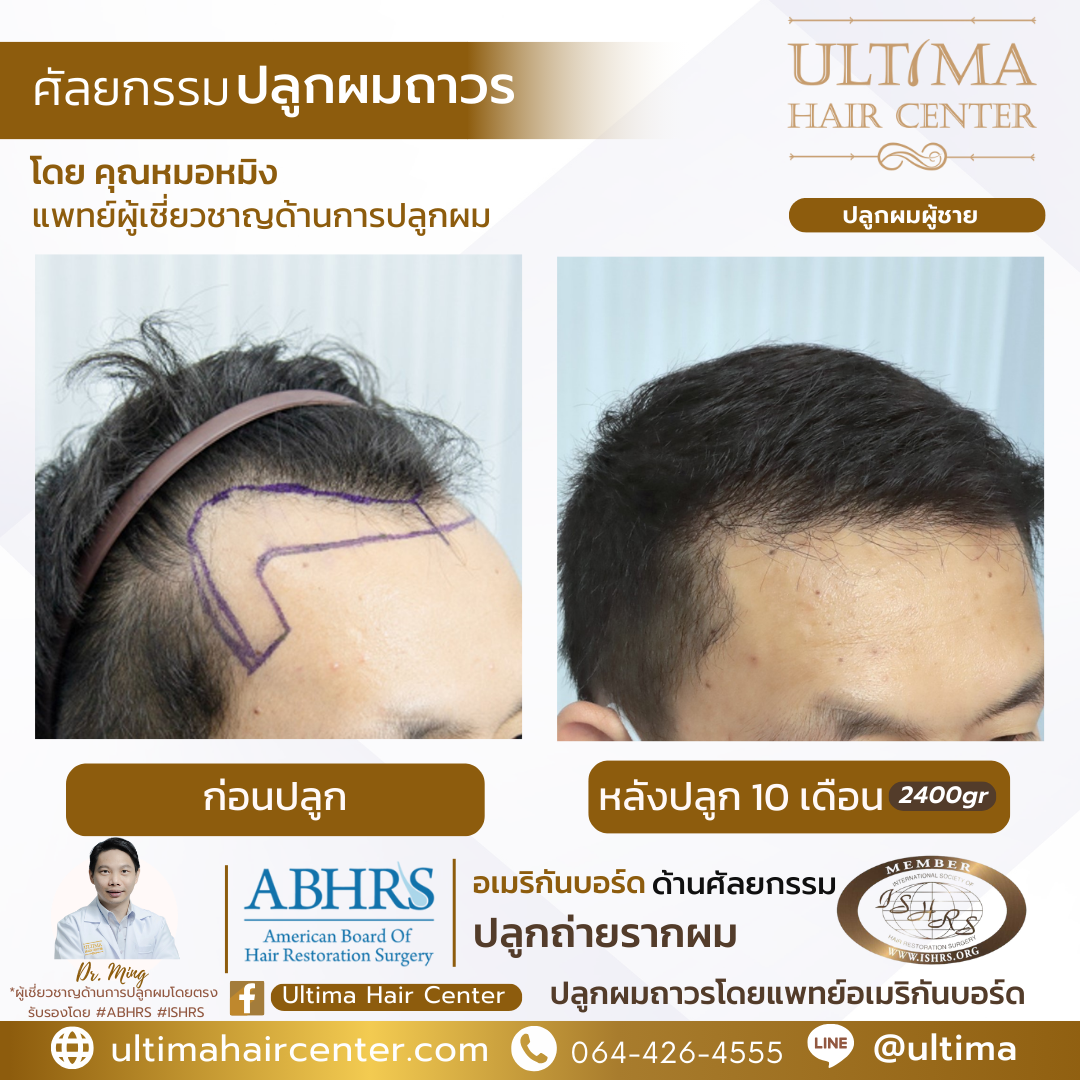 คลินิกรักษาผมร่วง