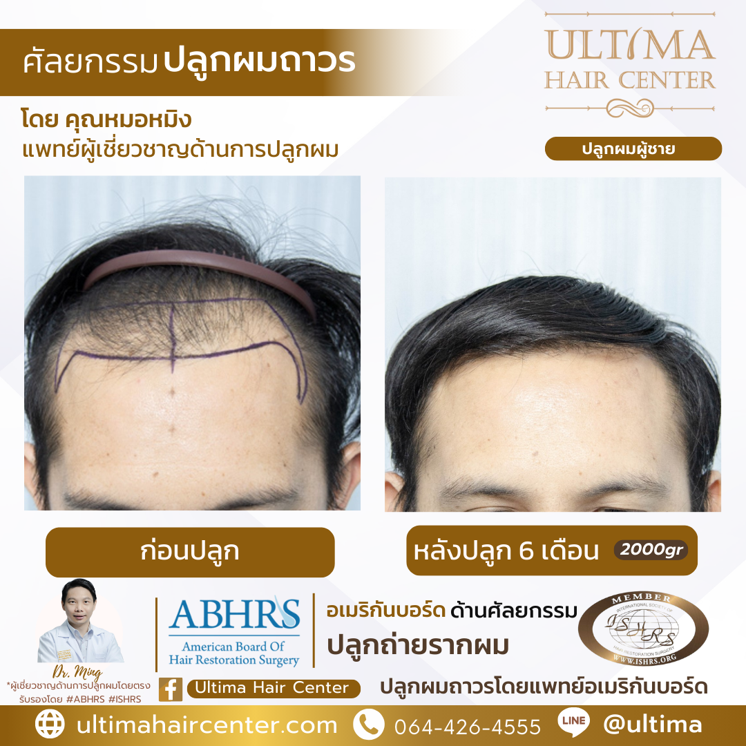 คลินิกรักษาผมร่วง