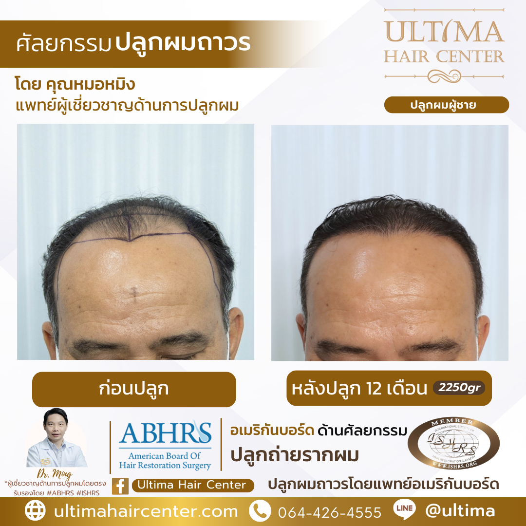 คลินิกรักษาผมบาง