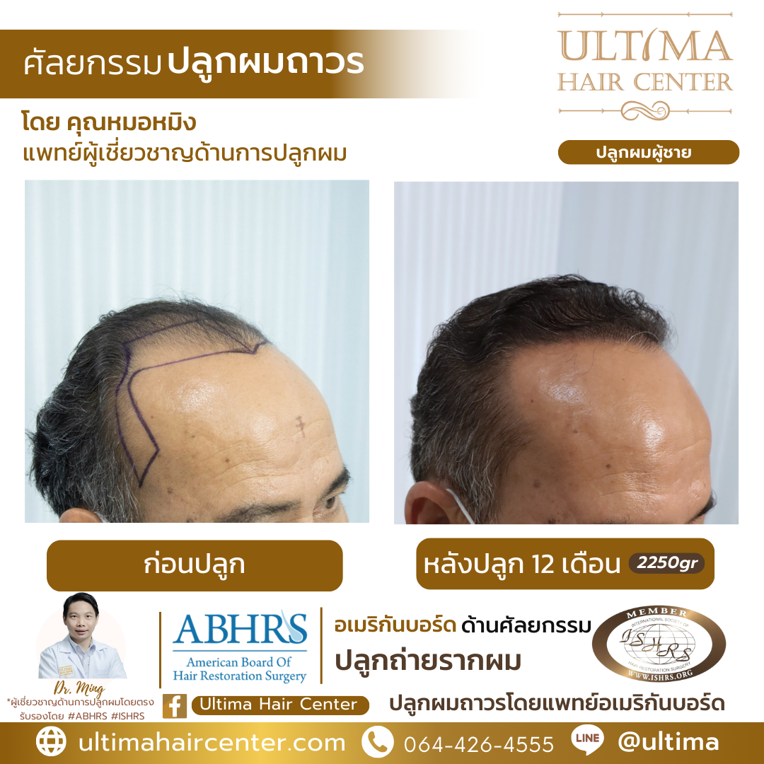 คลินิกปลูกผม กทม