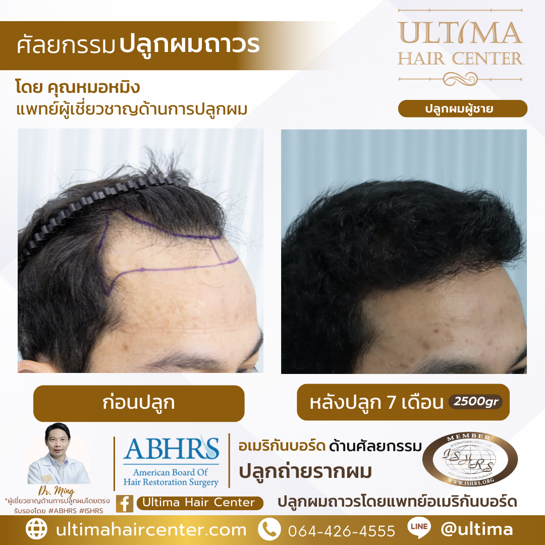 แก้ คิ้วบาง ผู้ชาย ด้วยการปลูกคิ้วได้ไหม 