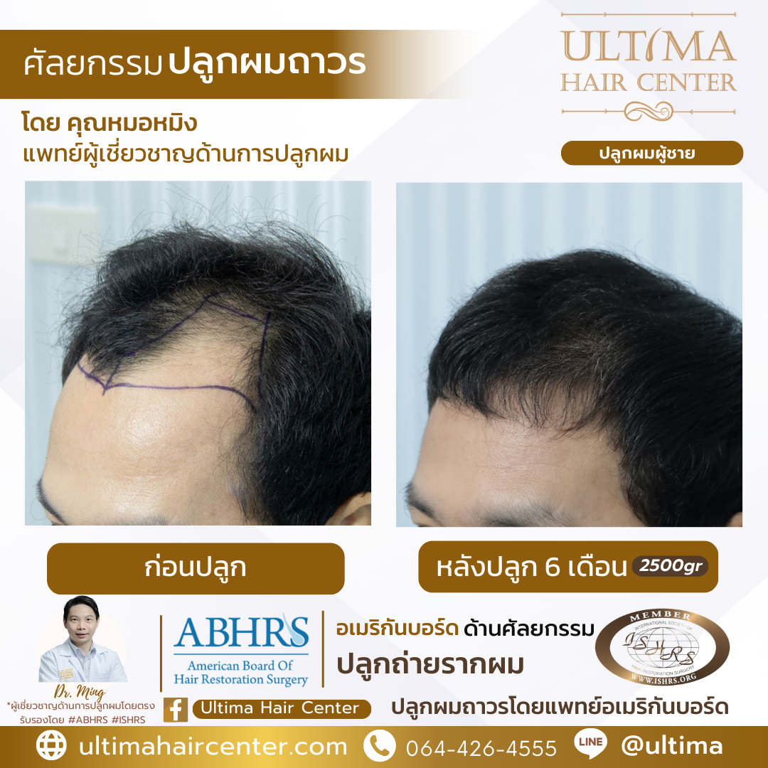 แก้ คิ้วบาง ผู้ชาย ด้วยการปลูกคิ้วได้ไหม 