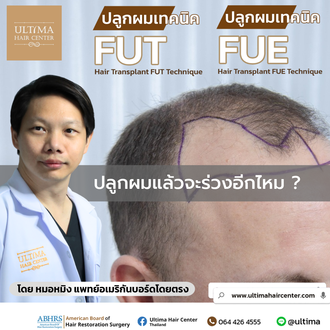 ปลูกผมแล้วจะร่วงอีกไหม