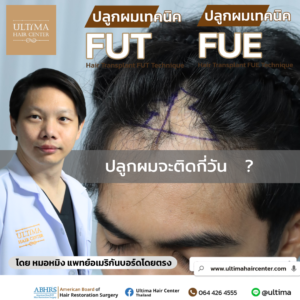 ปลูกผมแล้วผมจะติดกี่วัน