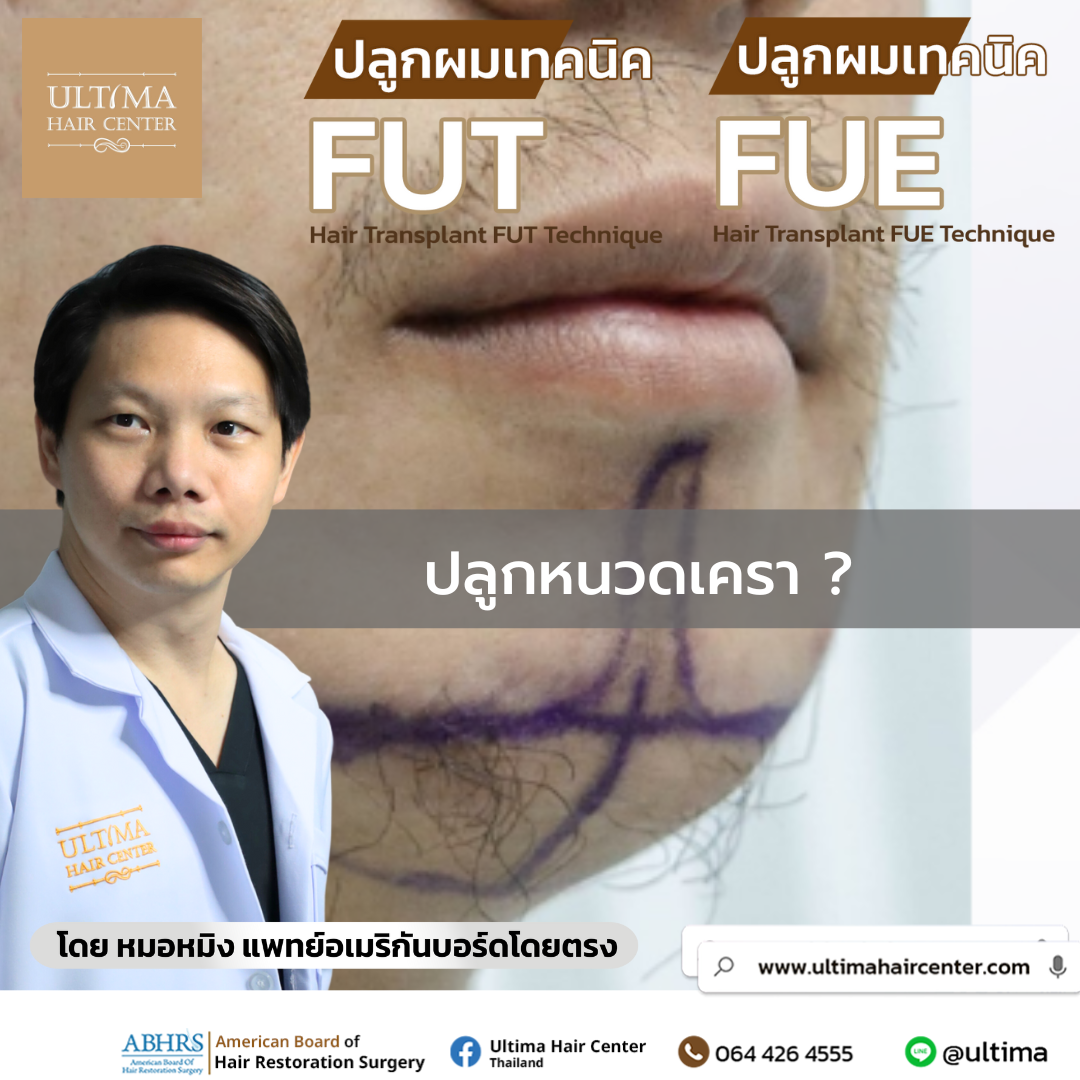 ปลูกหนวดเครา 