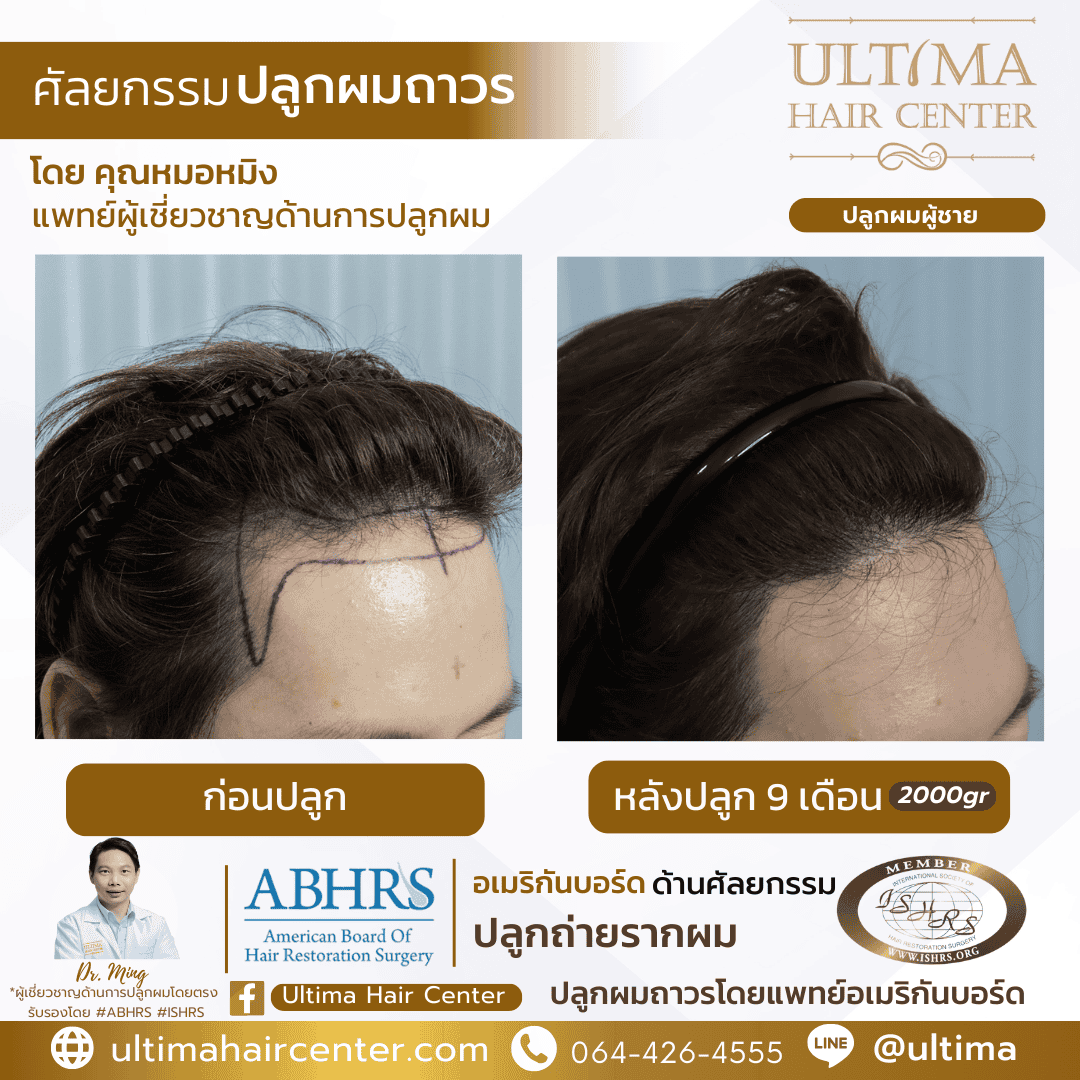 ปลูกผม FUE ต้องพักฟื้นนานไหม