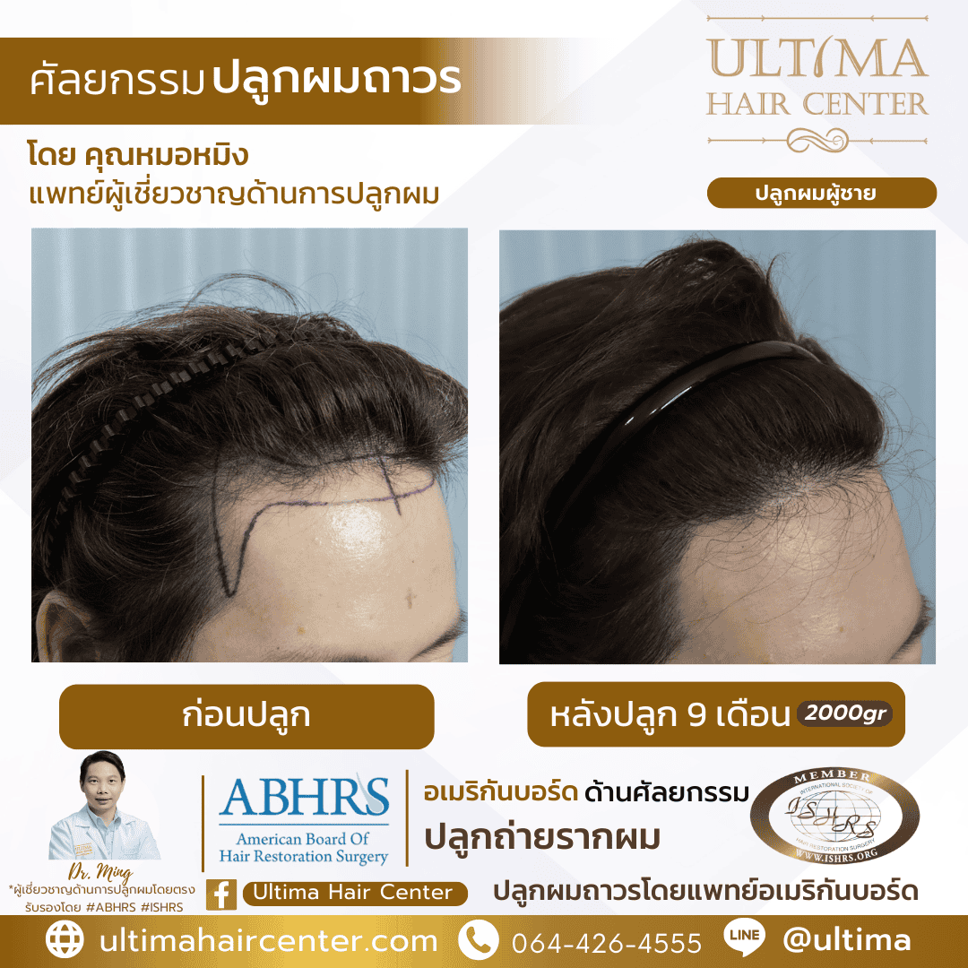 ปลูกผม FUE ต้องพักฟื้นนานไหม