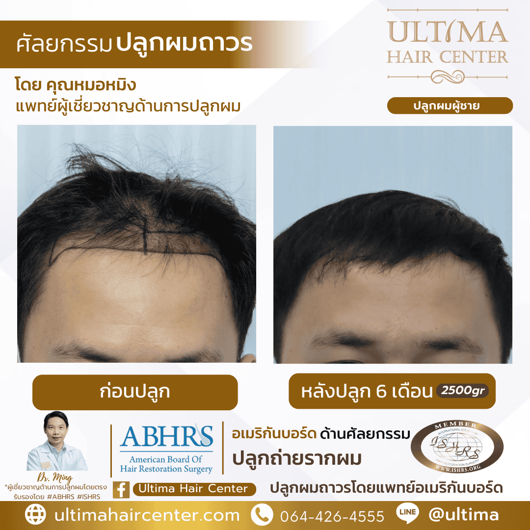 ปลูกผม FUE ต้องพักฟื้นนานไหม