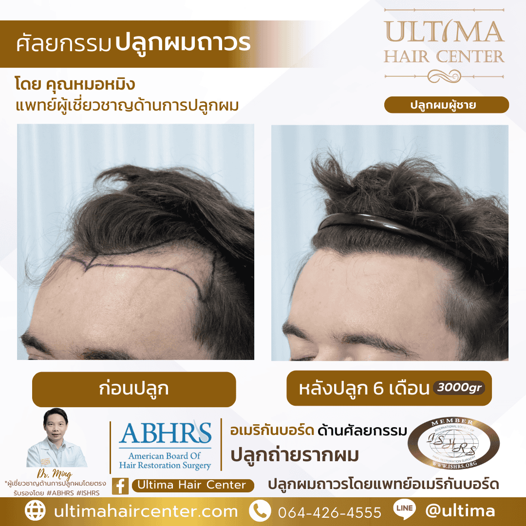 การเตรียมตัวก่อนปลูกผม FUE