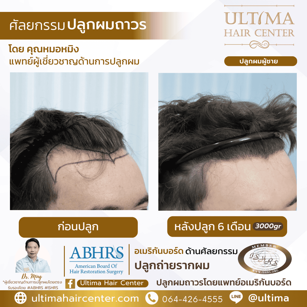 การเตรียมตัวก่อนปลูกผม FUE